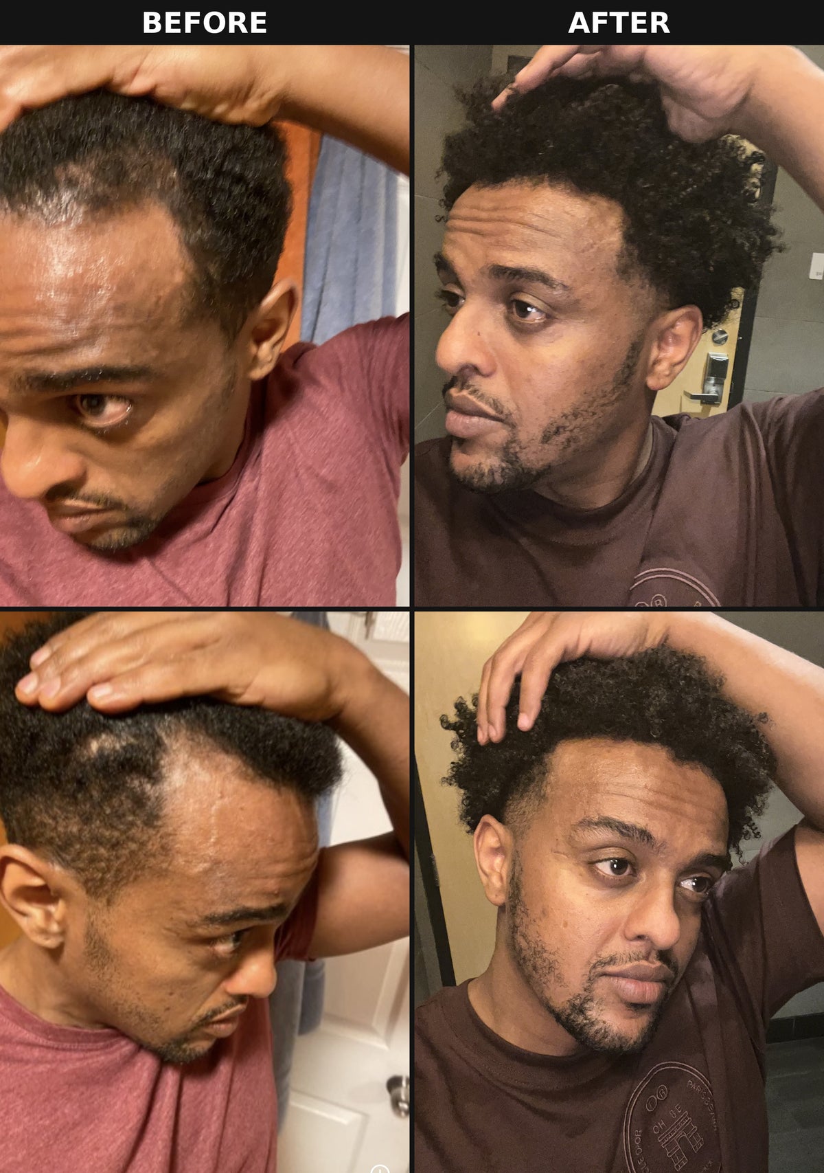 Before and after results using The Formula rosemary hair oil for thinning hair