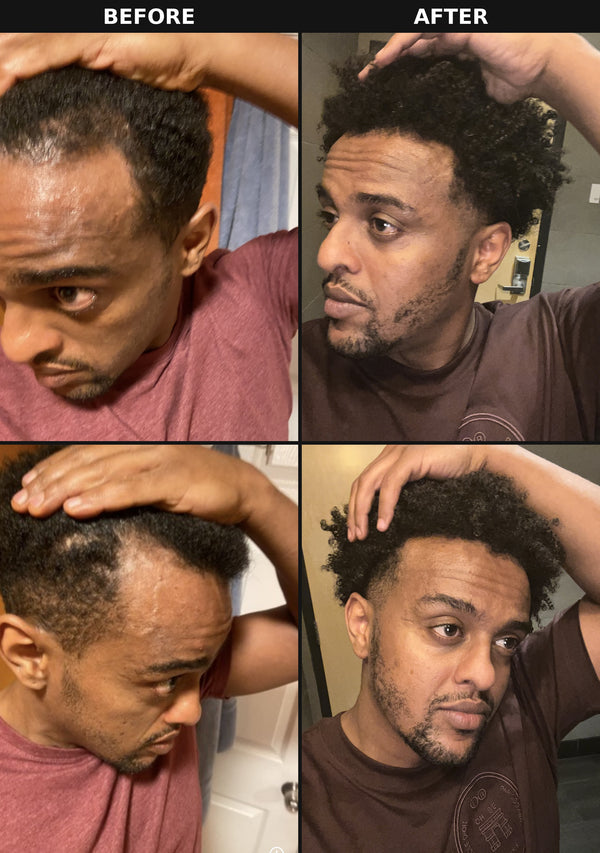 Before and after results using The Formula rosemary hair oil for thinning hair